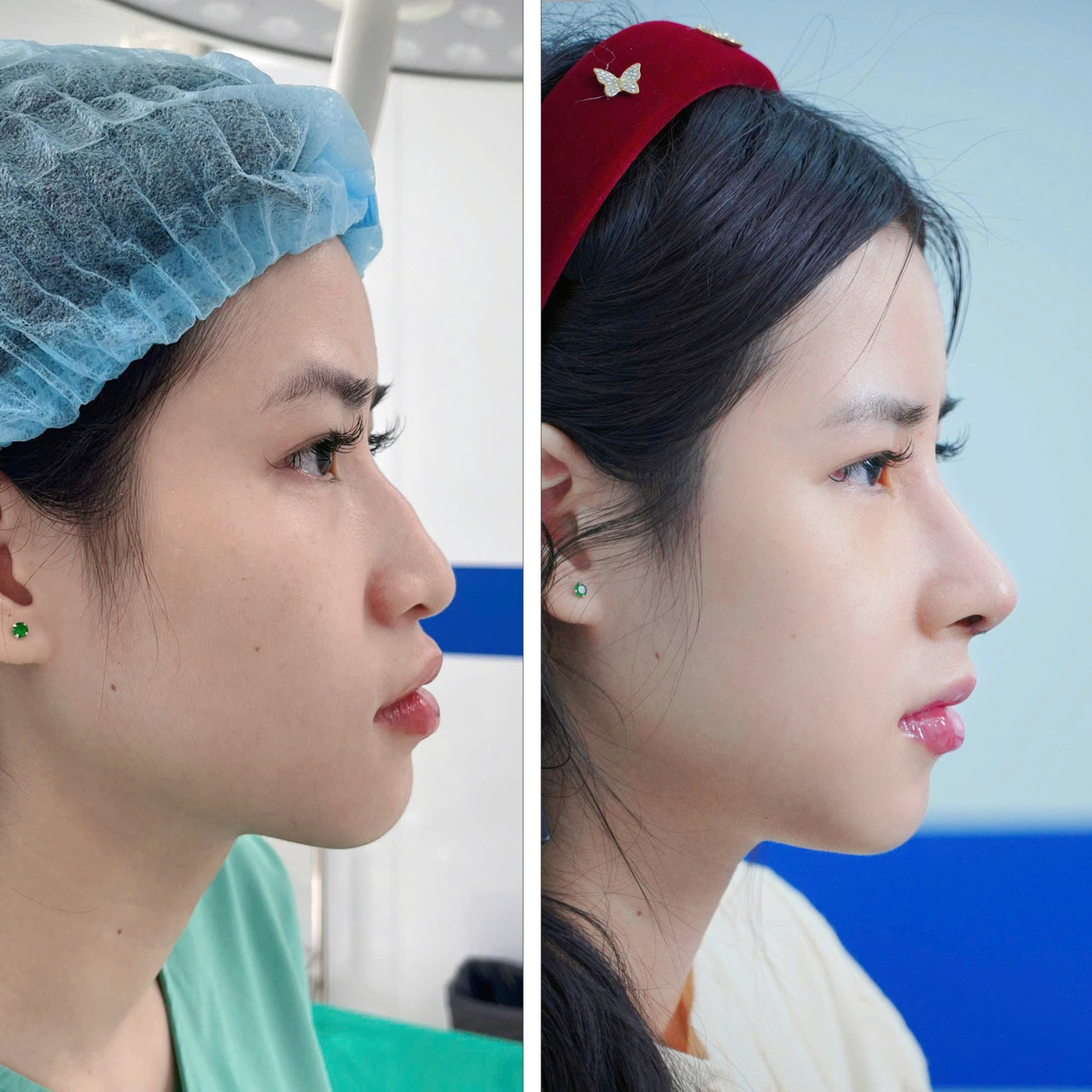 Nâng Mũi Cấu Trúc Cùng Bs.Nguyễn Xuân Long: Tối Ưu Hồi Phục Bằng Kỹ Thuật Xâm Lấn Tối Thiểu - ảnh 3