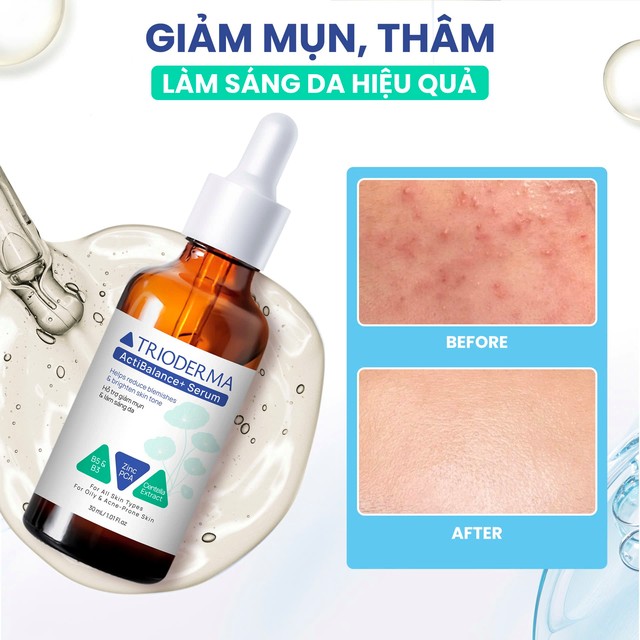 Hướng dẫn sử dụng serum giảm mụn và hỗ trợ làm sáng da Trioderma ActiBalance+ Serum chuẩn y khoa - ảnh 2