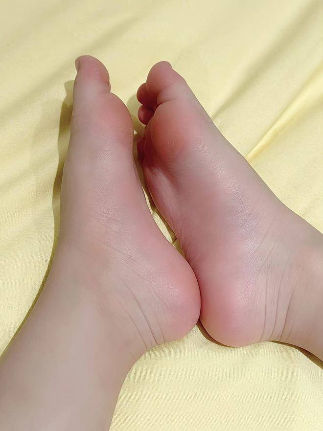 Con gái Đoàn Di Băng vừa được phát hiện mắc dị tật bàn chân bẹt