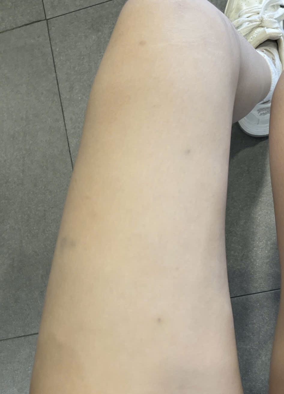 Bộ “Thăng Long Hội” nặng gần 30kg, với kết cấu đồ sộ và nhiều chi tiết kim loại cồng kềnh, đã khiến cơ thể Yến Nhi xuất hiện không ít vết bầm tím.