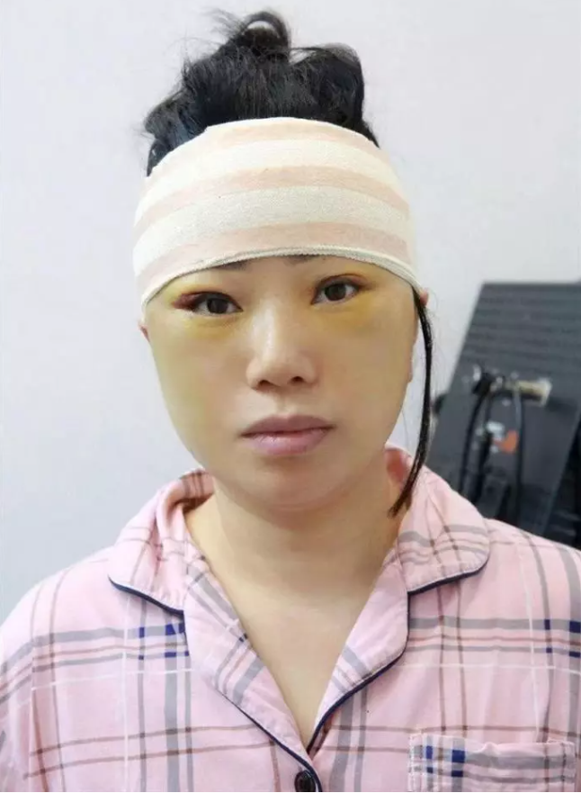 Cô cho biết 3 ngày đầu sau khi căng da mặt, gương mặt cô gần như tê liệt, việc cử động hàm rất khó khăn. (Ảnh: Internet)
