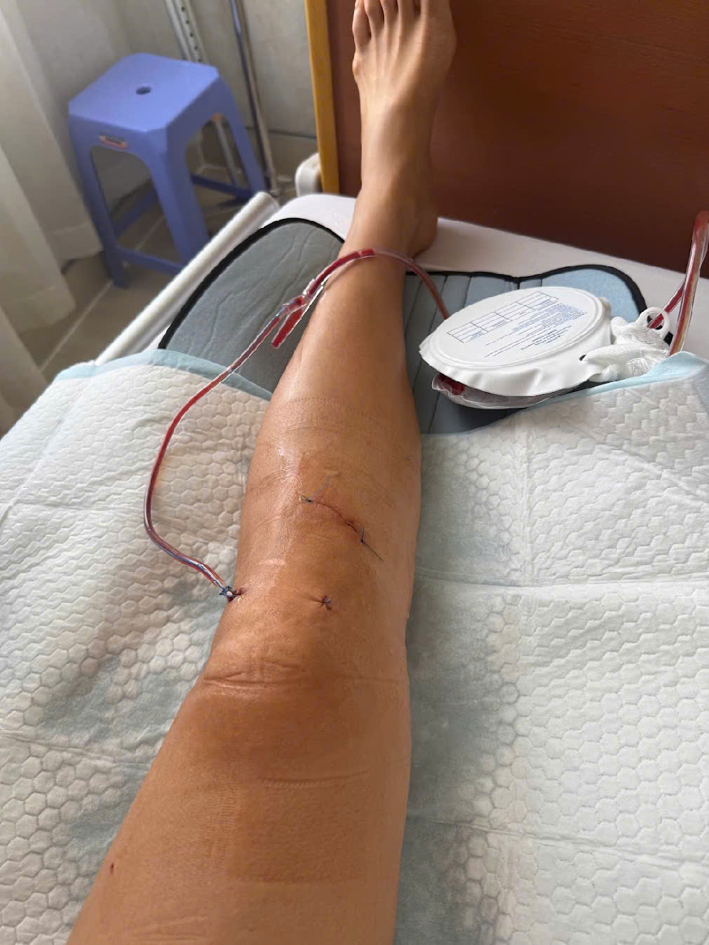 Minh Tú bị đứt dây chằng chéo trước, rách sụn chêm và dập xương sau chấn thương tại “Sao Nhập Ngũ” - ảnh 1