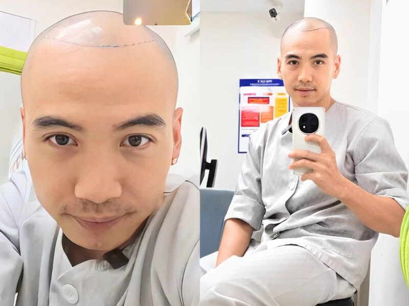 Diện mạo chồng H'Hen Niê sau nửa năm trị hói đầu - ảnh 3