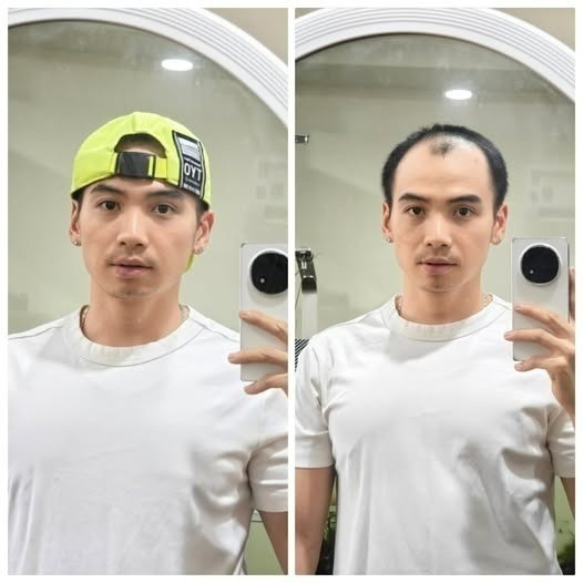 Diện mạo chồng H'Hen Niê sau nửa năm trị hói đầu - ảnh 6