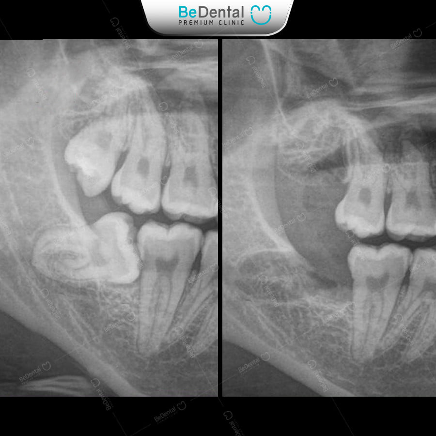 Nhổ răng khôn an toàn không biến chứng tại nha khoa thẩm mỹ Bedental - ảnh 2