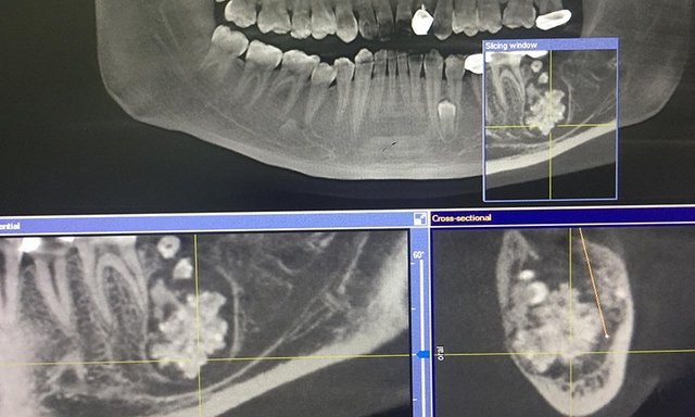 Quảng Bình: Phát hiện 28 chiếc răng lớn nhỏ nằm chen chúc trong khối u răng của bé trai 9 tuổi - ảnh 1