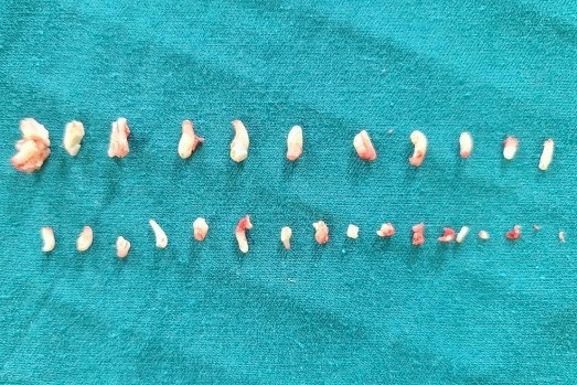 Những chiếc răng được gấp ra từ khối u của bệnh nhân.