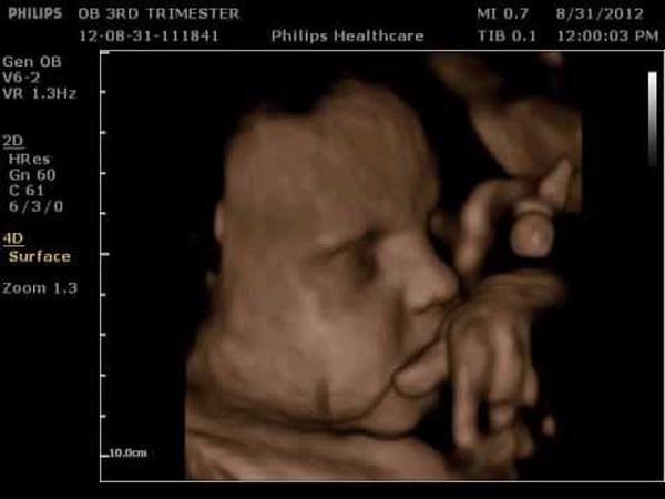 Cả thai kỳ siêu âm con trai, gia đình ngớ người khi con chào đời lại là “công chúa 3,2 kg” - ảnh 2