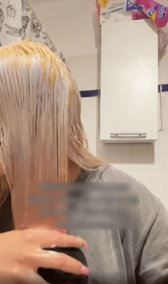 Tự tẩy tóc tại nhà cho tiết kiệm, cô gái rước họa vào thân: Tóc rụng nguyên mảng, hói cả đầu - ảnh 3