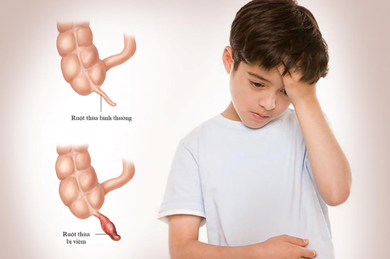 Bác sĩ cảnh báo viêm ruột thừa ở trẻ lại tiến triển nhanh, phụ huynh nên quan tâm con nhiều hơn.