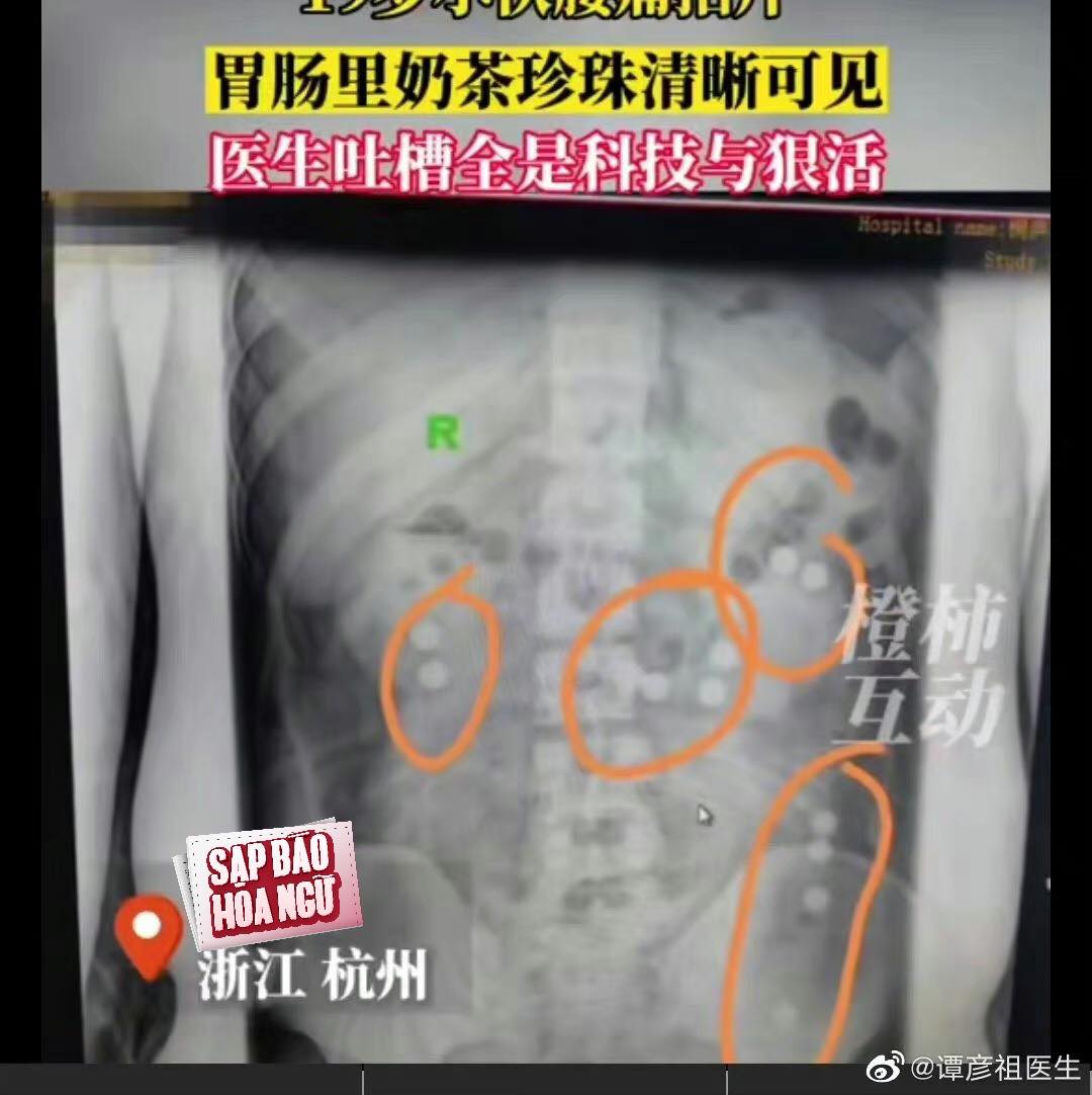 Kết quả chụp X-quang bên trong trong cơ thể chàng trai toàn trân châu khiến bác sĩ sốc ngang.