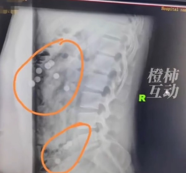 Hình ảnh chụp CT của chàng trai ở Trung Quốc với các khối cầu tròn