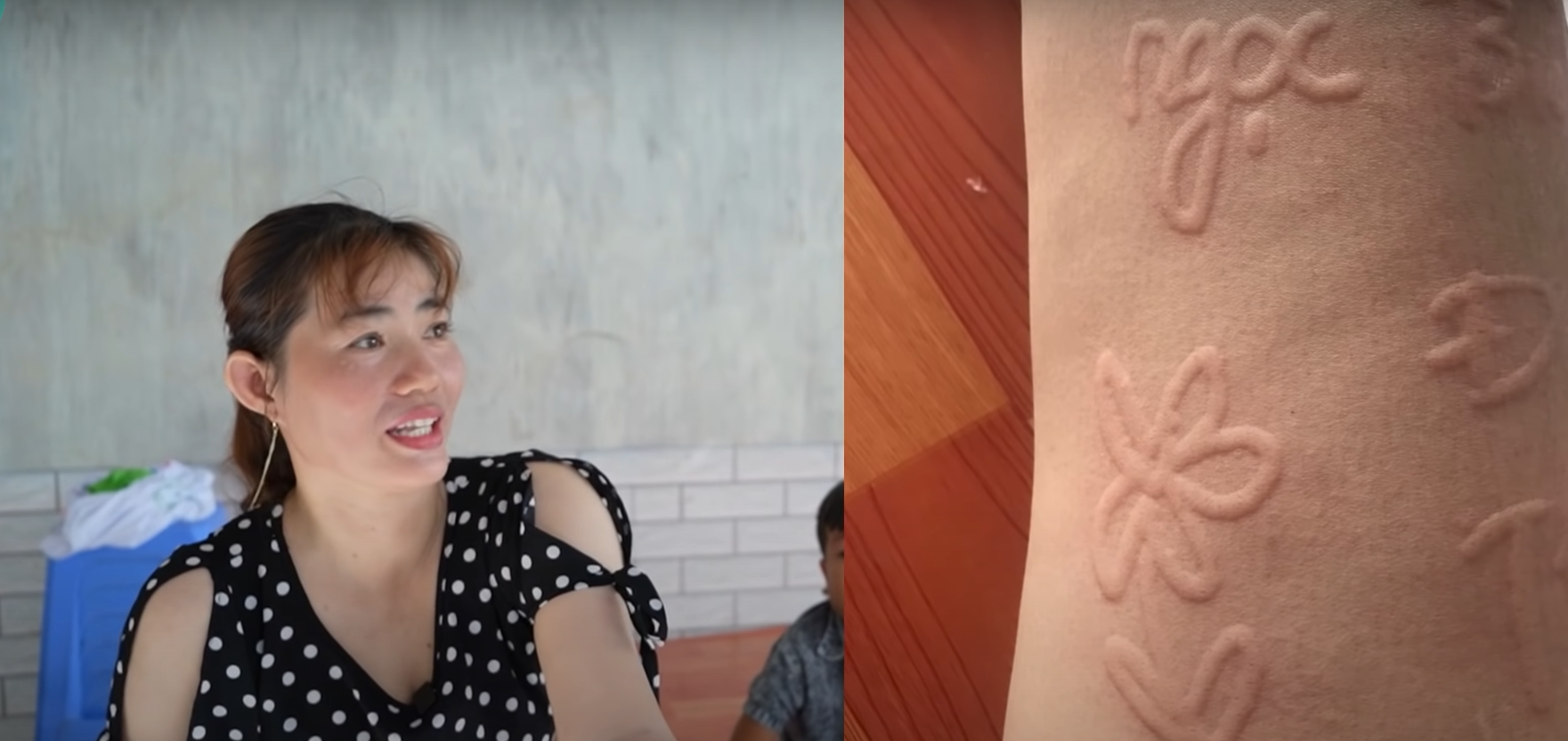 Hai người phụ nữ sở hữu làn da có thể viết chữ, vẽ tranh nổi lên như 3D, bác sĩ không tìm ra nguyên nhân - ảnh 3