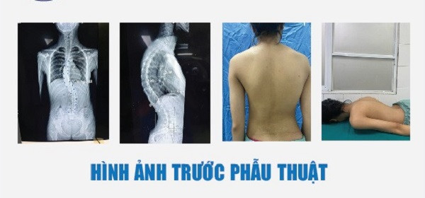 Ngồi học sai tư thế nhiều năm, nữ sinh bị cong vẹo cột sống phải bắt 22 chiếc vít để nắn lại - ảnh 2