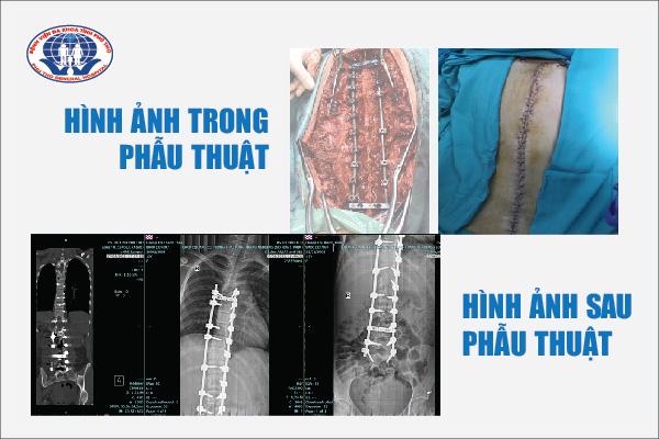 Nhiều năm ngồi học sai tư thế, nữ sinh 15 tuổi bị vẹo cột sống phải bắt 22 vít nắn chỉnh lại (Ảnh: Sức khỏe& Đời sống)