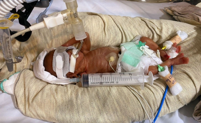 Hình ảnh em bé sinh non nặng 460 gram, không khóc, không có phản xạ, được bác sĩ cấp cứu và nuôi sống thành công.