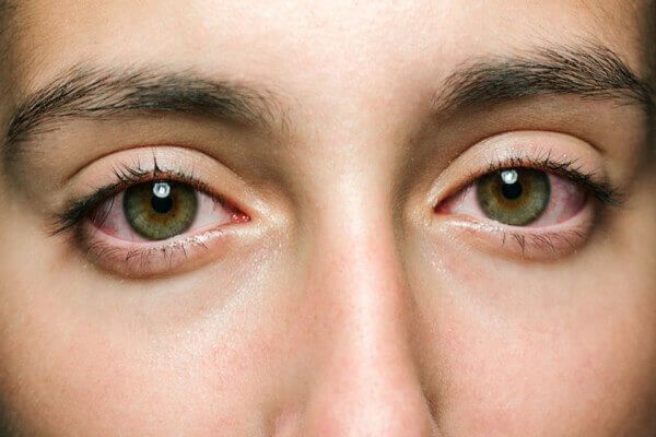 Nếu có đốm đen ngày càng to trên mống mắt thì nên đi tầm soát ung thư càng sớm càng tốt.