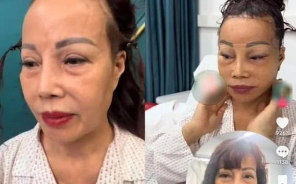 Cô dâu Thu Sao U70 tiến hành phẫu thuật căng da mặt