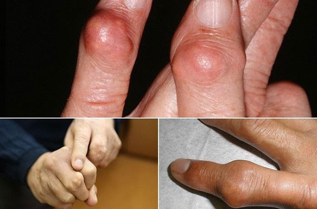 Thấy bàn tay có 1 trong 3 dấu hiệu này thì nên thận trọng bởi rất có thể là khối u ác tính? - ảnh 3