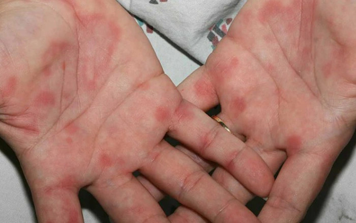 Thấy bàn tay có 1 trong 3 dấu hiệu này thì nên thận trọng bởi rất có thể là khối u ác tính? - ảnh 4