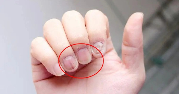 Thấy bàn tay có 1 trong 3 dấu hiệu này thì nên thận trọng bởi rất có thể là khối u ác tính? - ảnh 2