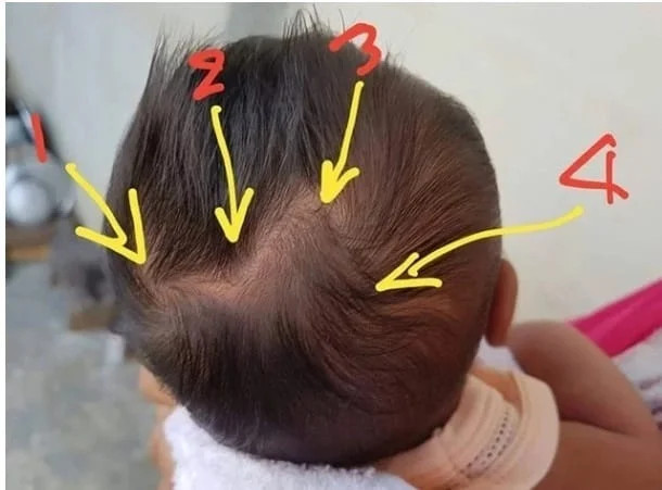 Trẻ em có 2 xoáy tóc rõ trên đầu khả năng thông minh hơn người khác, các bác sĩ lên tiếng? - ảnh 3