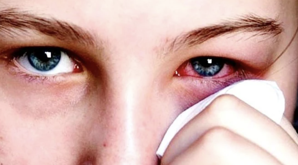 Bệnh đau mắt đỏ dễ lây lan trong mùa hè.