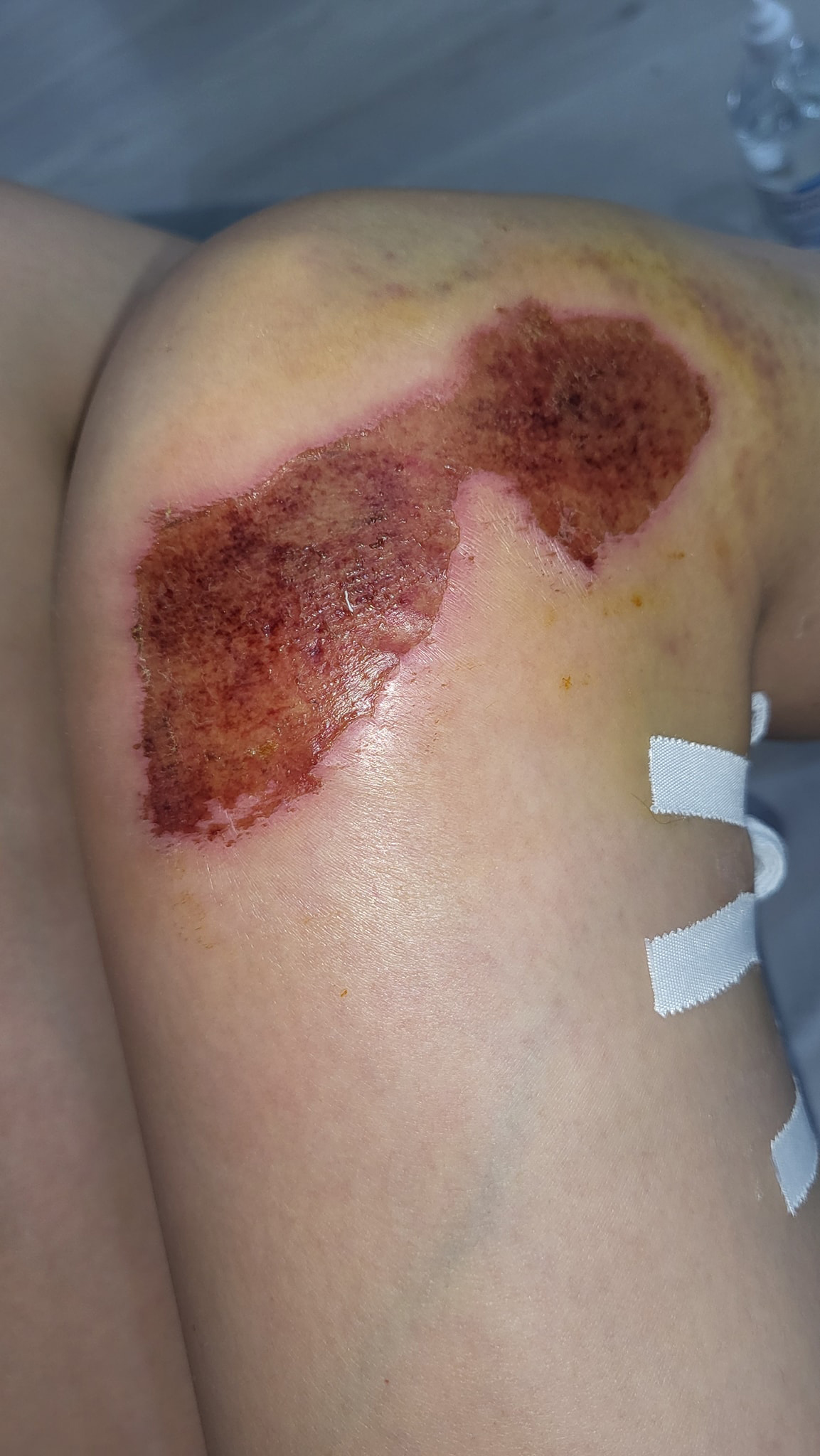 Vết thương nặng ở chân Ngọc Trinh có thể để lại sẹo, cô nàng khẳng định không cố ý bị tai nạn để đánh bóng tên tuổi. Ảnh: FBNV