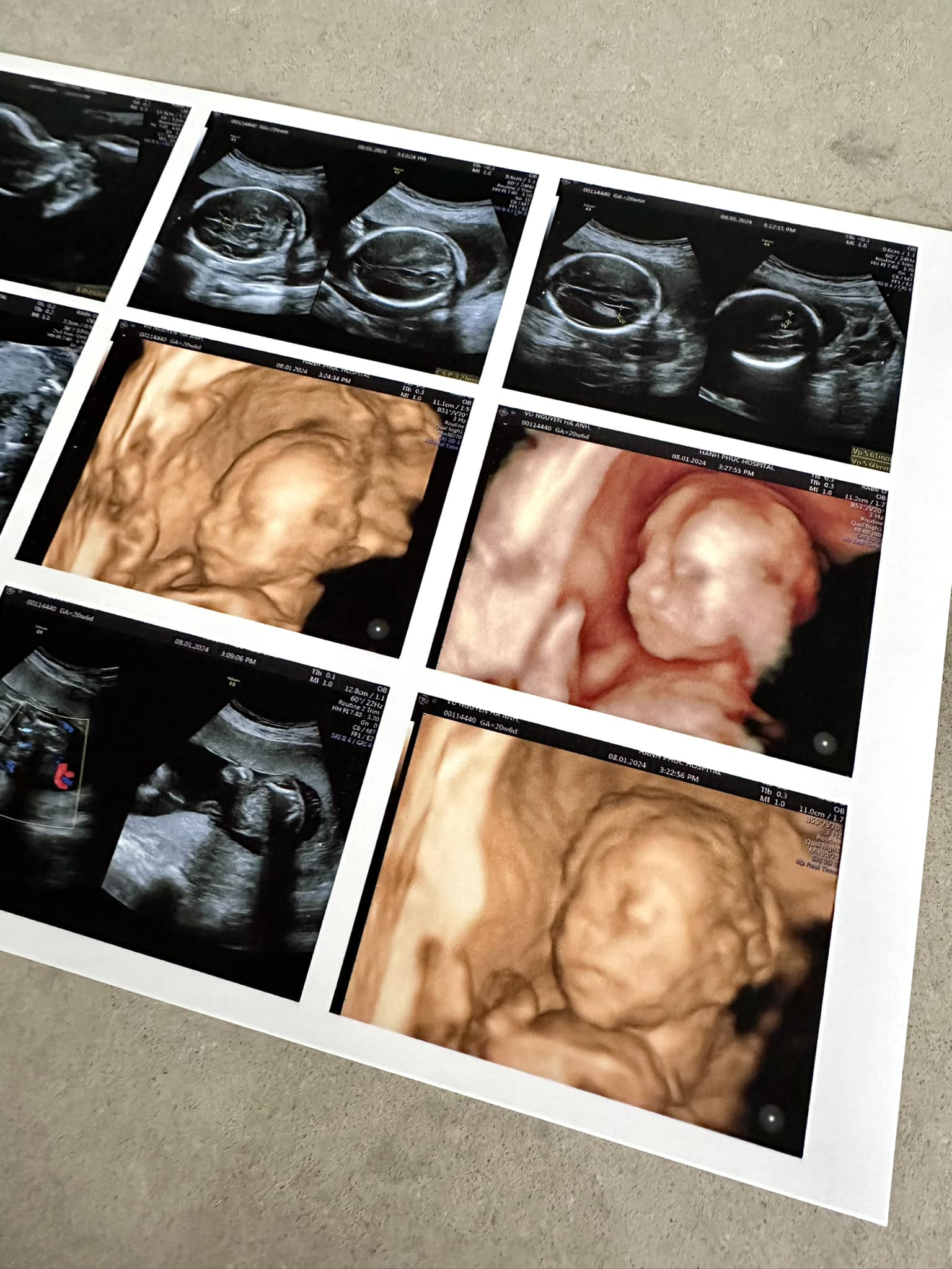 Hà Anh khoe hình ảnh siêu âm con, nhiều người đoán cô nàng đang mang thai 1 bé trai. Ảnh: FBNV