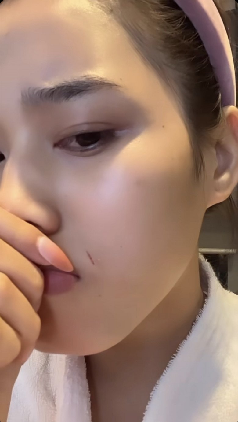 Một nàng hậu Việt gặp sự cố khi chăm da, nhan sắc xinh đẹp bị ảnh hưởng nặng - ảnh 3