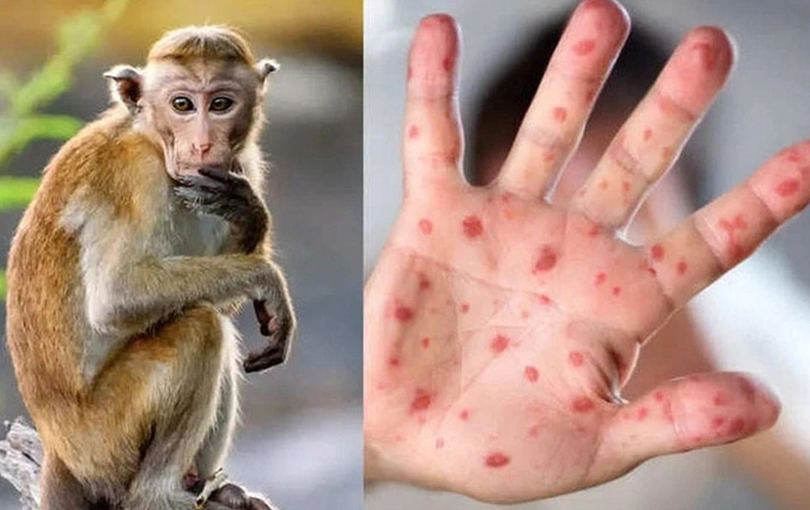 Bệnh nhân mắc đậu mùa khỉ đầu tiên tử vong tại TP.HCM, ngành Y tế ra khuyến cáo phải đặc biệt lưu ý - ảnh 3