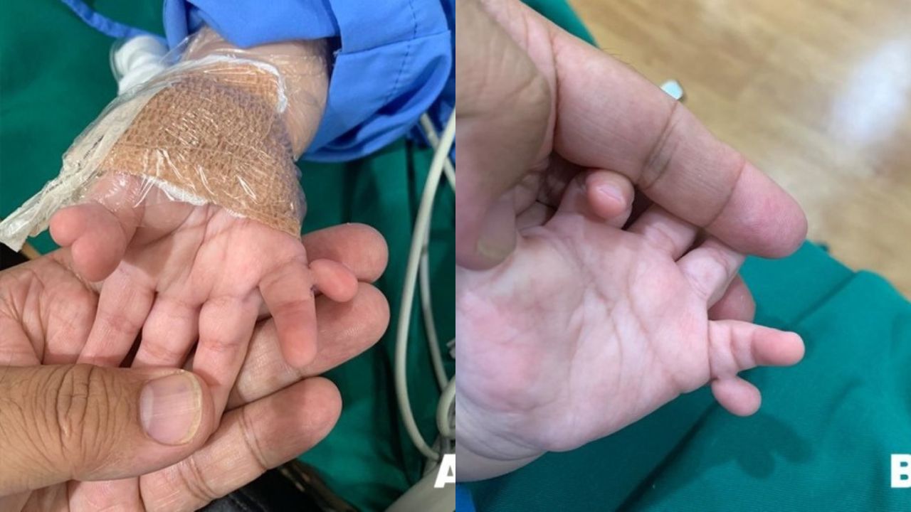 Ngón cái bàn tay phải của bé gái bị chẻ làm đôi (trái), ngón út phải lại bị dư mẩu thịt nhỏ - Ảnh: Tâm Anh