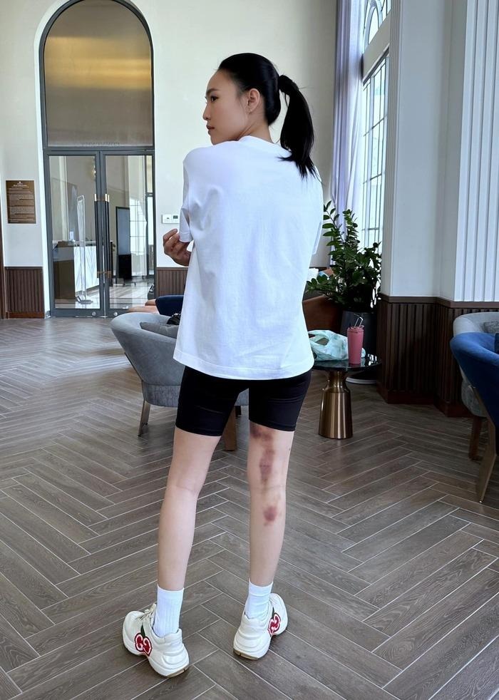 Hình ảnh Ninh Dương Lan Ngọc cùng vết bầm tím lớn ở chân khiến các fan lo lắng