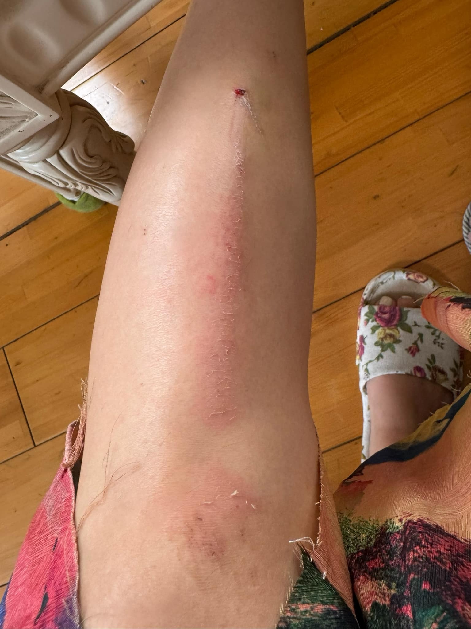 Ngọc Trinh đăng tải hình ảnh bản thân suýt bị gãy chân do té cầu thang