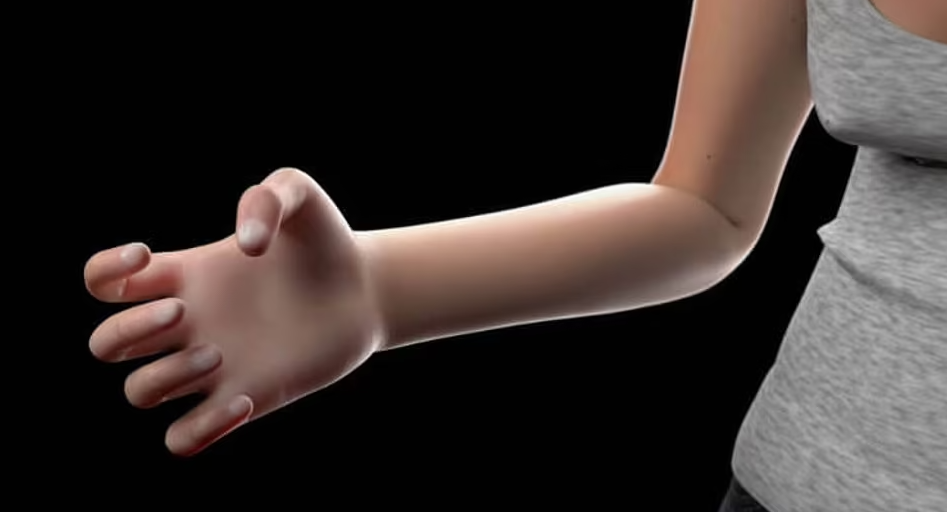 Bàn tay co quắp, xuất hiện tình trạng 'text claw' vì cầm nắm điện thoại thường xuyên 
