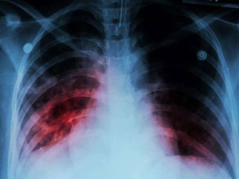 Ảnh chụp lá phổi của một bệnh nhân mắc bệnh lao