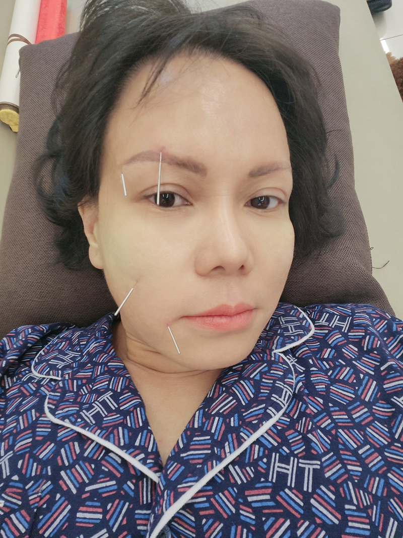 Việt Hương điều trị châm cứu sau khi gặp sự cố sức khỏe