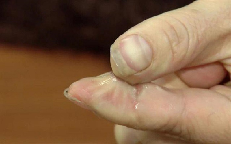Hai ngón tay bị dính vào nhau có thể áp dụng mẹo để gỡ ra