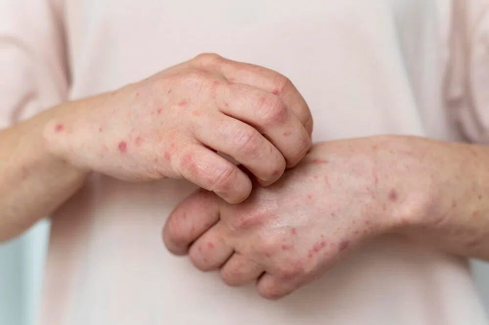 Người mắc bệnh đậu mùa khỉ thường phát ban ngoài da