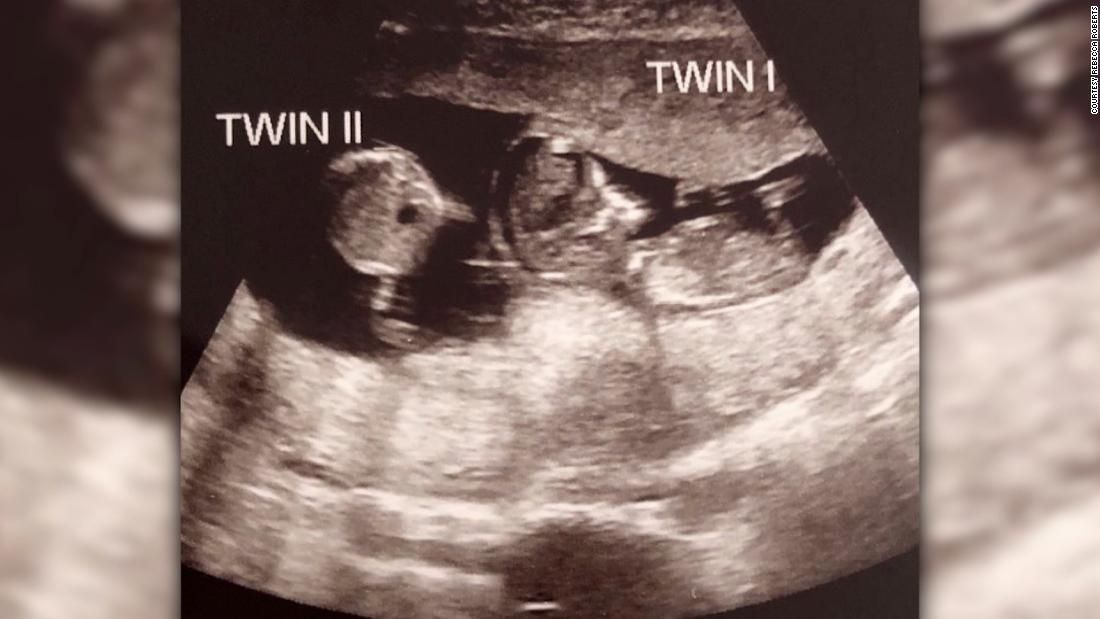 Ảnh chụp siêu âm của người phụ nữ mang thai khi đang có bầu