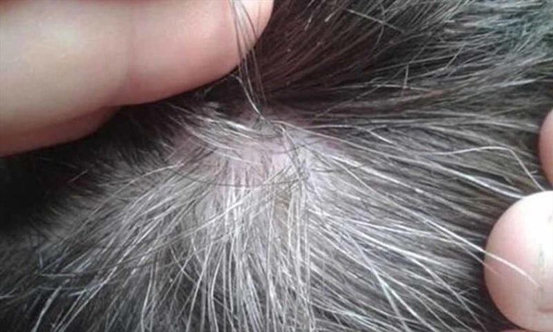 Nhổ tóc bạc thường xuyên khiến tóc mỏng hơn và dễ bị hói