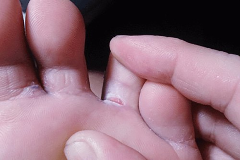 Các kẽ ngón chân là nơi dễ sản sinh nấm móng