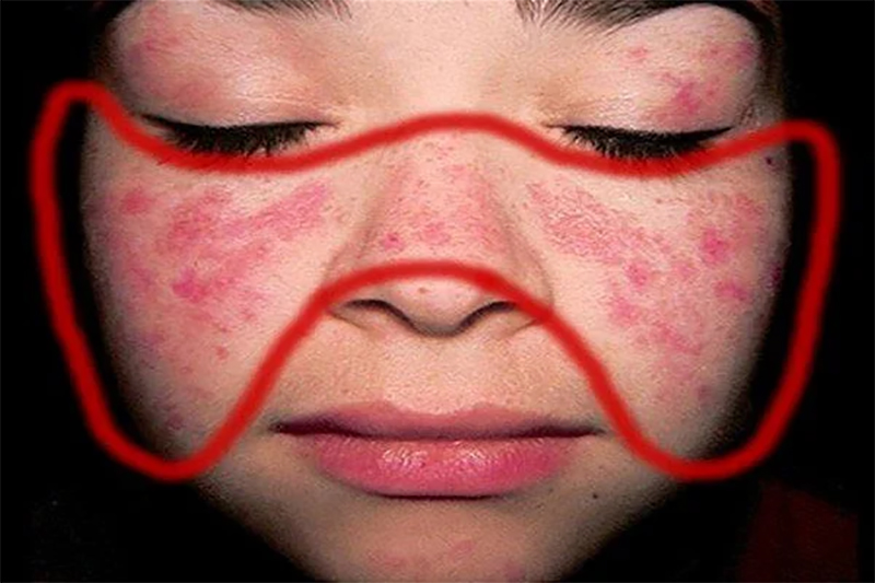 Đặc điểm của người mắc bệnh lupus ban đỏ là có vết đỏ hình cánh bướm xuất hiện trên mặt