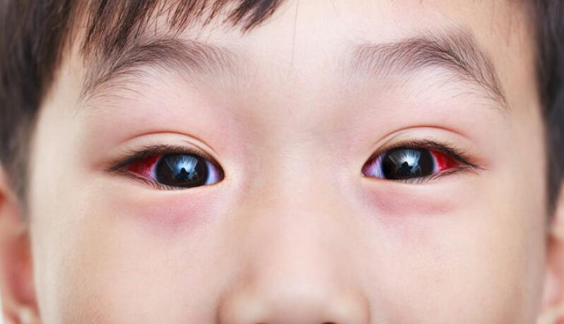 Đau mắt đỏ là trường hợp thường xuyên xảy ra đối với mọi người, nhất là ở trẻ em