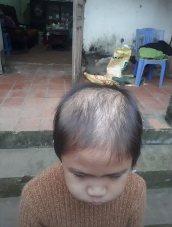 Hồi sinh mái tóc cho bé gái mắc bệnh lạ, 8 tuổi rụng trọc đầu - ảnh 1