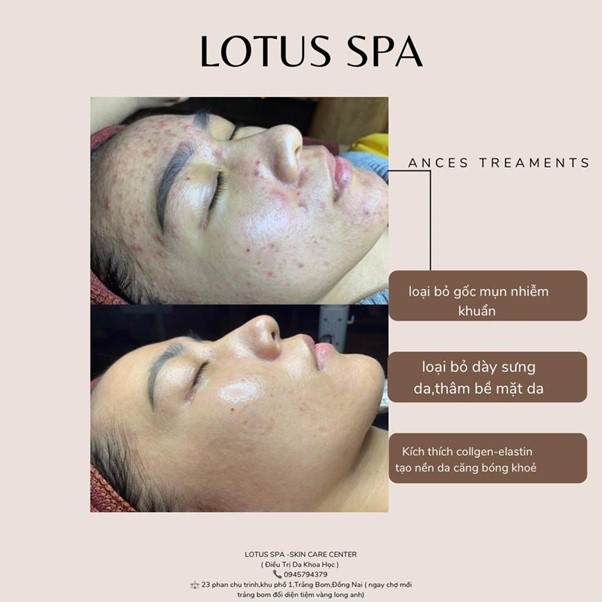 Lotus Spa - Khi chuyên nghiệp đi đôi với cái tâm: Khám phá qui trình chăm sóc da chuyên sâu và hiệu quả - ảnh 3