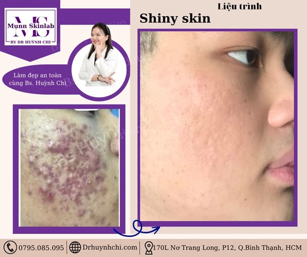 Trị mụn không cần nặn mụn cùng bác sĩ Huỳnh Kim Chi - ảnh 5