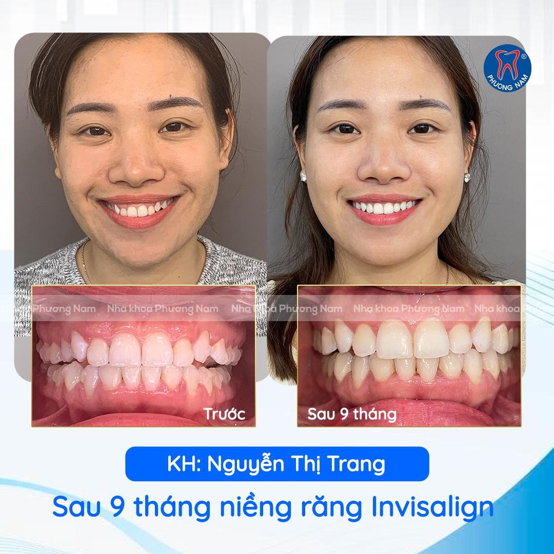 Khám phá nụ cười mới Invisalign cùng Bác sĩ Ngô Tùng Phương - Chuyên gia về niềng răng không mắc cài - ảnh 4