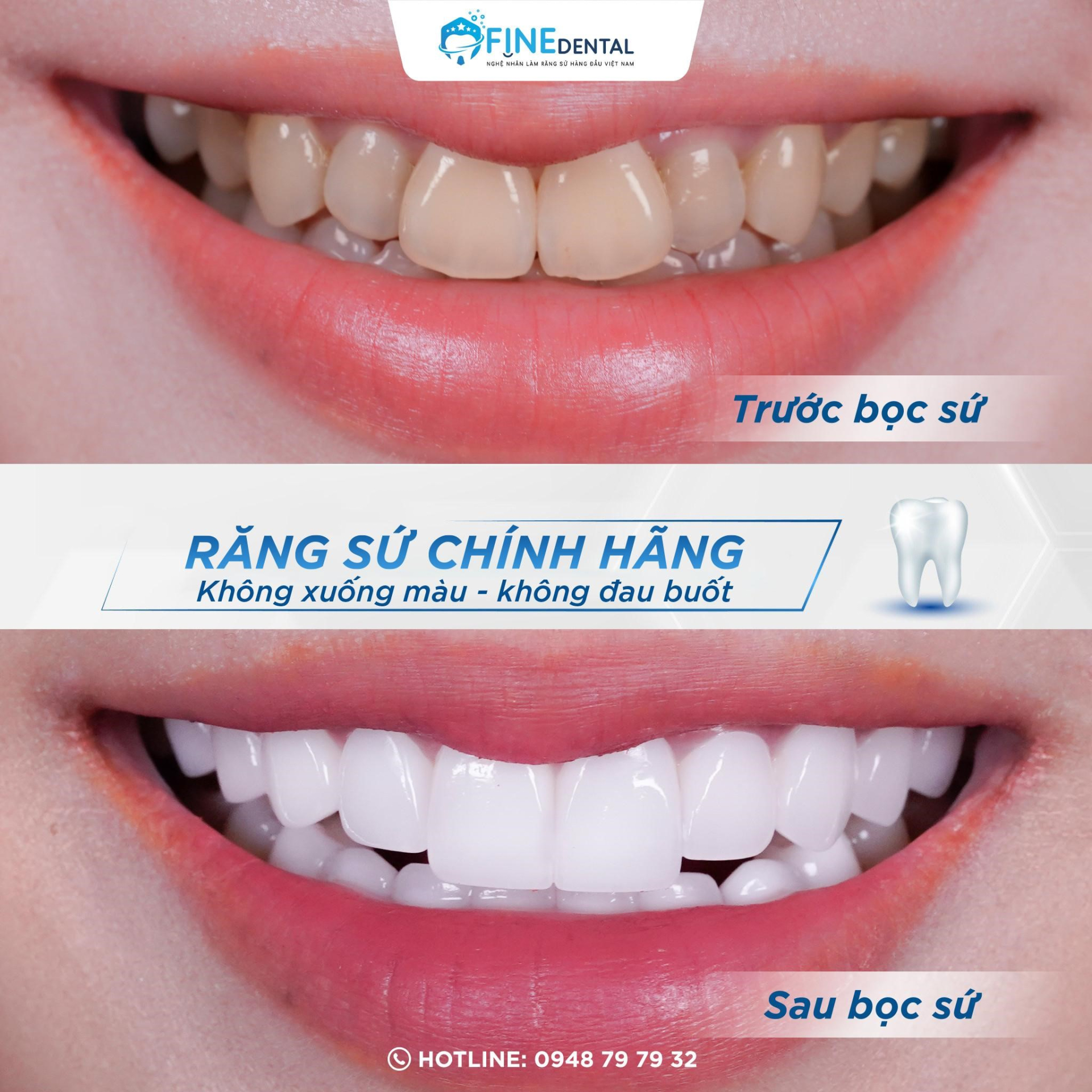 Cải thiện khuyết điểm nụ cười nhờ bọc răng sứ thẩm mỹ tại Nha khoa Fine Dental - ảnh 2