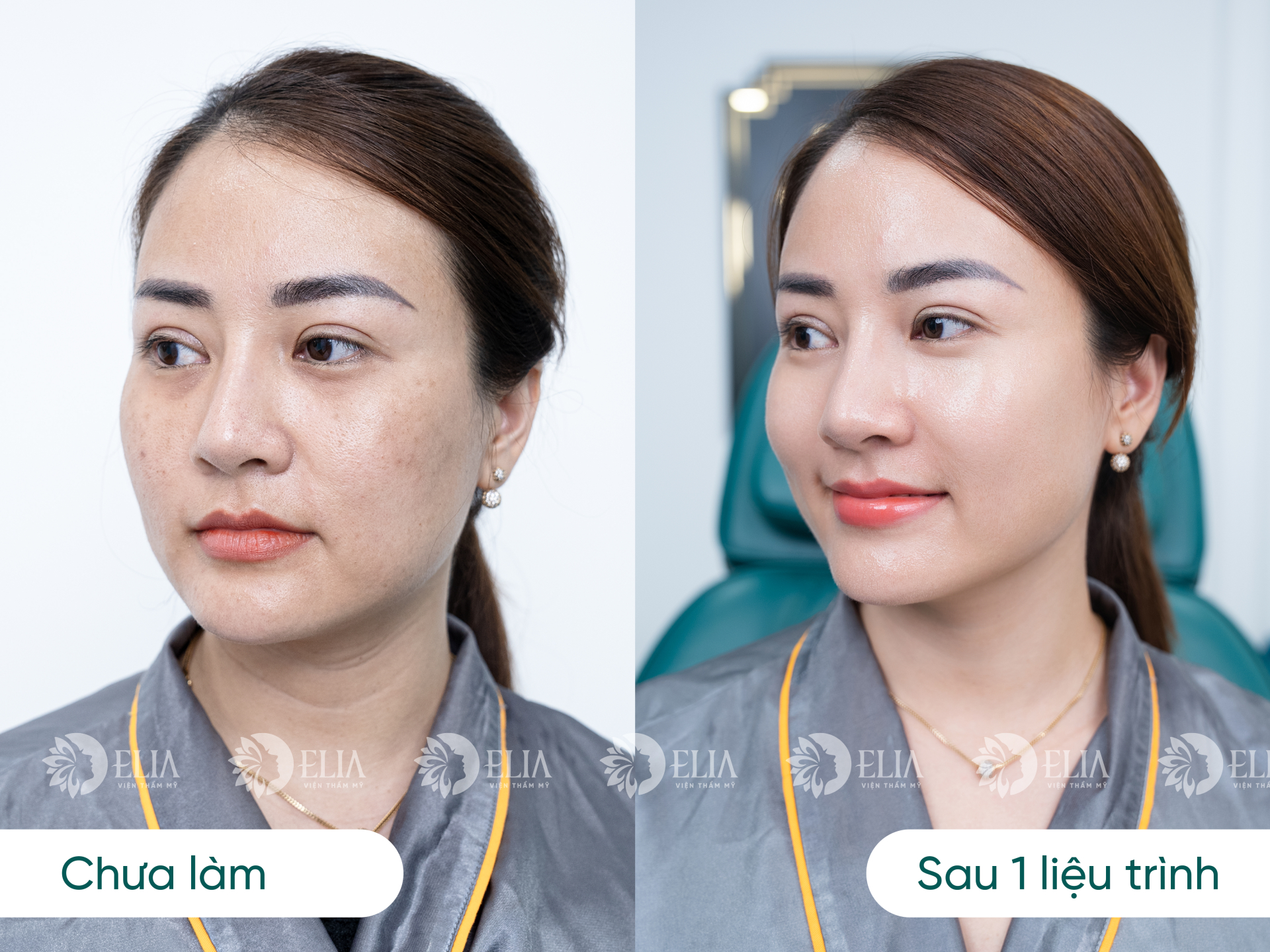 Giải mã cơn sốt cấy Meso Bio Young không nốt sần tại Viện thẩm mỹ quốc tế Elia - ảnh 5